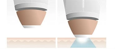 Инновационная фотоэпиляция с Silk-expert 5 IPL